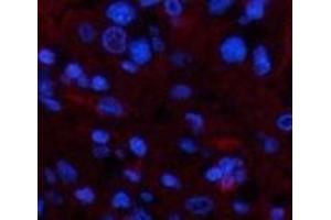 Immunofluorescence analysis of Human liver cancer tissue using TTR Monoclonal Antibody at dilution of 1:200. (TTR antibody)
