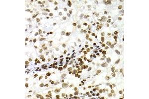 Immunohistochemistry (Paraffin-embedded Sections) (IHC (p)) image for anti-Nuclear Factor of kappa Light Polypeptide Gene Enhancer in B-Cells 2 (NFKB2) (AA 690-899) antibody (ABIN3017388)