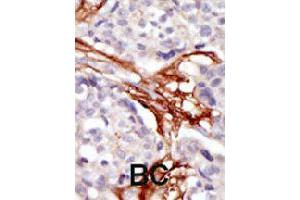 Formalin-fixed and paraffin-embedded human cancer tissue reacted with YES1 polyclonal antibody  , which was peroxidase-conjugated to the secondary antibody, followed by AEC staining. (YES1 antibody  (N-Term))