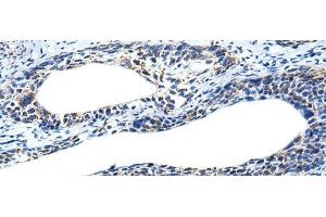 Immunohistochemistry of paraffin-embedded Human cervical cancer tissue using IRF5 Polyclonal Antibody at dilution of 1:25(x200) (IRF5 antibody)