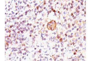Formalin-fixed, paraffin-embedded human Hodgkin's Lymphoma stained with Bax Mouse Monoclonal Antibody (2D2). (BAX antibody  (AA 3-16))