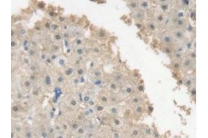 Detection of CRP in Human Liver cancer Tissue using Polyclonal Antibody to C Reactive Protein (CRP) (CRP antibody  (AA 17-224))
