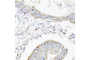 Immunohistochemistry of paraffin-embedded human colon carcinoma using SDC2 antibody at dilution of 1:100 (x40 lens). (Syndecan 2 antibody)