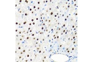 Immunohistochemistry of paraffin-embedded human liver cancer using SSB antibody at dilution of 1:100 (40x lens). (SSB antibody)
