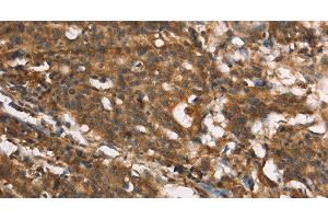 Immunohistochemistry of paraffin-embedded Human gastic cancer using MARC1 Polyclonal Antibody at dilution of 1:40 (MOSC1 antibody)