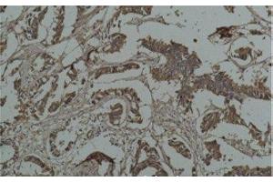Immunohistochemistry of paraffin-embedded Human breast carcinoma tissue using HSP27 Monoclonal Antibody at dilution of 1:200. (HSP27 antibody)
