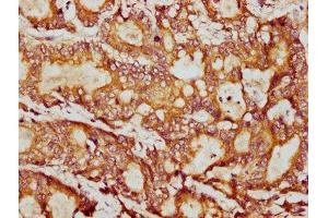 IHC image of ABIN7164994 diluted at 1:400 and staining in paraffin-embedded human colon cancer performed on a Leica BondTM system. (PSMB9 antibody  (AA 21-219))