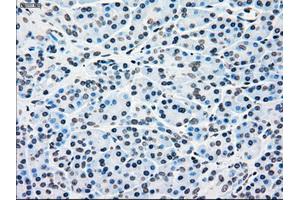 Immunohistochemical staining of paraffin-embedded Adenocarcinoma of breast tissue using anti-BRAF mouse monoclonal antibody. (BRAF antibody)