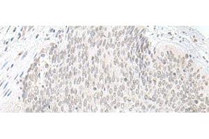 Immunohistochemistry of paraffin-embedded Human esophagus cancer tissue using ORC1 Polyclonal Antibody at dilution of 1:65(x200)