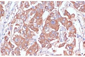 Immunohistochemistry of paraffin-embedded Human liver cancer using LRP1 Polyclonal Antibody at dilution of 1:100 (40x lens). (LRP1 antibody)