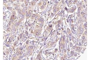 ABIN6273812 at 1/100 staining Human breast cancer tissue by IHC-P. (SRMS antibody  (C-Term))