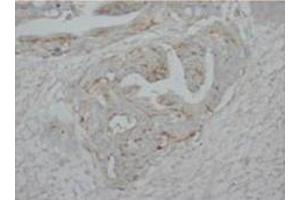 Immunohistochemical analysis of paraffin embedded HUman intestine cancer sections using P73alpha antibody (Tumor Protein p73 antibody  (C-Term))