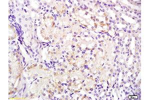Formalin-fixed and paraffin embedded human laryngeal carcinoma labeled with Anti-FPR1 Polyclonal Antibody, Unconjugated (ABIN742245) at 1:200 followed by conjugation to the secondary antibody and DAB staining (FPR1 antibody)
