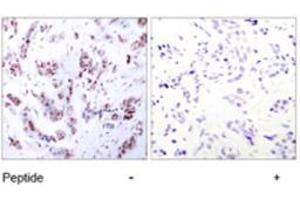 Immunohistochemical analysis of paraffin-embedded human breast carcinoma tissue using MEF2A polyclonal antibody  . (MEF2A antibody)