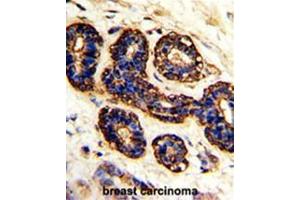 Formalin-fixed and paraffin-embedded human breast carcinoma with BEST2 Antibody (C-term), which was peroxidase-conjugated to the secondary antibody, followed by DAB staining.