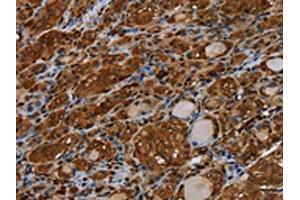 The image on the left is immunohistochemistry of paraffin-embedded Human thyroid cancer tissue using ABIN7191558(MYBBP1A Antibody) at dilution 1/40, on the right is treated with synthetic peptide. (MYBBP1A antibody)