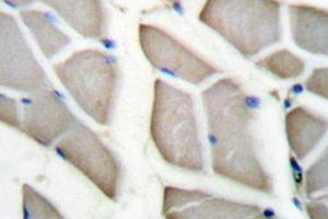 Immunohistochemistry (IHC) analyzes of 14-3-3 ζ (pVal52) antibody in paraffin-embedded human breast carcinoma tissue. (14-3-3 zeta antibody)