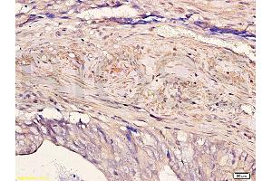 Formalin-fixed and paraffin embedded human colon carcinoma with Anti-Pokemon Polyclonal Antibody, Unconjugated (ABIN729448) at 1:200, followed by conjugation to the secondary antibody and DAB staining