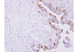 IHC-P Image POR antibody detects POR protein at cytoplasm on human ovarian carcinoma by immunohistochemical analysis. (POR antibody  (N-Term))