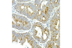 Immunohistochemistry of paraffin-embedded human colon carcinoma using MRPS15 Rabbit mAb (ABIN7268582) at dilution of 1:250 (40x lens). (MRPS15 antibody)