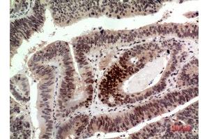 Immunohistochemistry (IHC) analysis of paraffin-embedded Human Colon Cancer, antibody was diluted at 1:100. (Histone H2A antibody  (Internal Region))