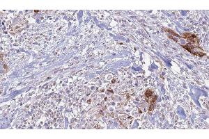 ABIN6277697 at 1/100 staining Human urothelial cancer tissue by IHC-P. (Integrin Alpha2b antibody  (Internal Region))