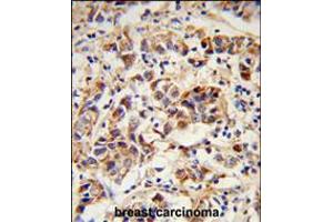 Formalin-fixed and paraffin-embedded human breast carcinoma reacted with SPRR1B Antibody , which was peroxidase-conjugated to the secondary antibody, followed by DAB staining.