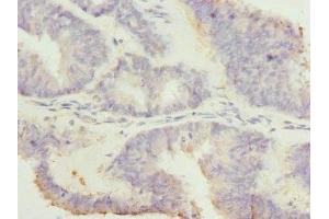 Immunohistochemistry of paraffin-embedded human endometrial cancer using ABIN7167620 at dilution of 1:100 (RGS7 antibody  (AA 1-300))