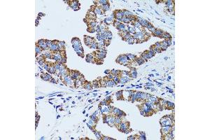 Immunohistochemistry of paraffin-embedded human gastric cancer using GIP antibody (ABIN1882357) at dilution of 1:100 (40x lens). (GIP antibody)