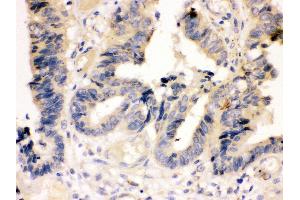 Anti-Caspase-7(P11) antibody, IHC(P) IHC(P): Human Intestinal Cancer Tissue (Caspase 7 antibody  (Middle Region))
