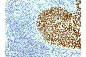 Formalin-fixed, paraffin-embedded human Cervical Carcinoma stained with SOX2 Mouse Monoclonal Antibody (SOX2/1791).