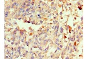 Immunohistochemistry of paraffin-embedded human melanoma using ABIN7166082 at dilution of 1:100 (40S Ribosomal Protein S3-B (RPS3.S) (AA 1-92) antibody)