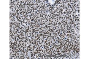 Immunohistochemistry of Human colon cancer using CMTM2 Polyclonal Antibody at dilution of 1:60 (CMTM2 antibody)
