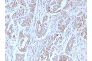Formalin-fixed, paraffin-embedded human Colon Carcinoma stained with ICOS-L Mouse Monoclonal Antibody (ICOSL/3111). (ICOSLG antibody  (AA 23-149))