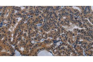 Immunohistochemistry of paraffin-embedded Human thyroid cancer tissue using INSIG2 Polyclonal Antibody at dilution 1:30 (INSIG2 antibody)