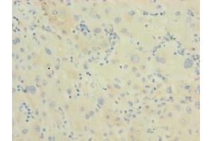 Immunohistochemistry of paraffin-embedded human liver cancer using ABIN7150510 at dilution of 1:100