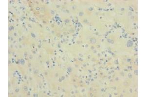 Immunohistochemistry of paraffin-embedded human liver cancer using ABIN7150510 at dilution of 1:100 (DNAJB14 antibody  (AA 1-244))