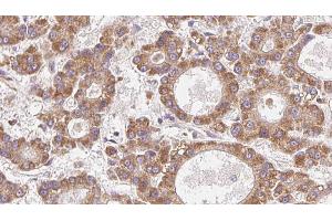 ABIN6272771 at 1/100 staining Human liver cancer tissue by IHC-P. (OR4N2 antibody)