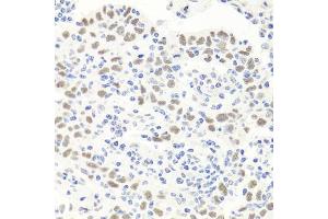 Immunohistochemistry of paraffin-embedded human esophageal cancer using EXO1 antibody (ABIN6129824, ABIN6140356, ABIN6140357 and ABIN6219087) at dilution of 1:100 (40x lens).