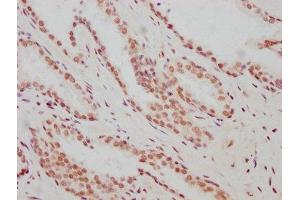 IHC image of ABIN7127344 diluted at 1:183 and staining in paraffin-embedded human prostate cancer performed on a Leica BondTM system. (Recombinant ARNT antibody)