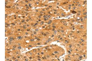 The image on the left is immunohistochemistry of paraffin-embedded Human liver cancer tissue using ABIN7192437(SLC24A4 Antibody) at dilution 1/35, on the right is treated with synthetic peptide. (SLC24A4 antibody)