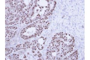 IHC-P Image Immunohistochemical analysis of paraffin-embedded NCIN87 Xenograft , using TAP , antibody at 1:100 dilution. (NXF1 antibody  (N-Term))