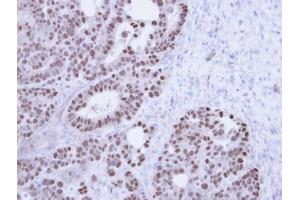 IHC-P Image Immunohistochemical analysis of paraffin-embedded NCIN87 Xenograft , using TAP , antibody at 1:100 dilution.