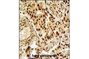 HDAC2 Antibody (Center) (ABIN653718 and ABIN2843029) immunohistochemistry analysis in formalin fixed and paraffin embedded human lung carcinoma followed by peroxidase conjugation of the secondary antibody and DAB staining.