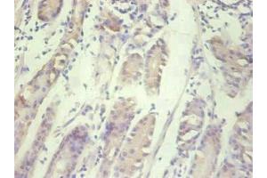 Immunohistochemical of paraffin-embedded human gastric cancer tissue using ABIN7156932 at dilution of 1:200. (IL-8 antibody)