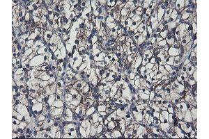 Immunohistochemical staining of paraffin-embedded Carcinoma of Human kidney tissue using anti-SH2D2A mouse monoclonal antibody. (SH2D2A antibody)