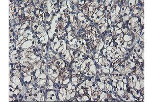 Immunohistochemical staining of paraffin-embedded Carcinoma of Human kidney tissue using anti-SH2D2A mouse monoclonal antibody.
