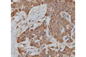ABIN6279217 at 1/200 staining human lymphoma tissue sections by IHC-P. (slc25a13 antibody  (C-Term))