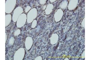 Immunoperoxidase of monoclonal antibody to RAP2B on formalin-fixed paraffin-embedded human malignant lymphoma, diffuse large B tissue. (RAP2B antibody  (AA 1-183))