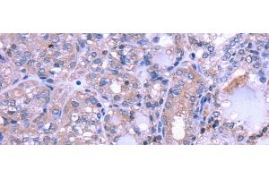Immunohistochemistry of paraffin-embedded Human thyroid cancer using THRSP Polyclonal Antibody at dilution of 1/30 (THRSP antibody)